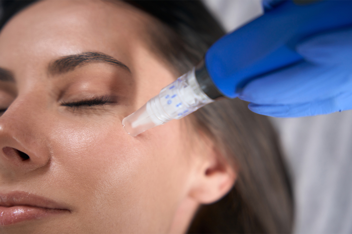 A young woman receives microneedling in Solana Beach.