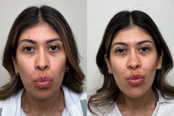 Before and after results of a woman who got chin Botox in Solana Beach.