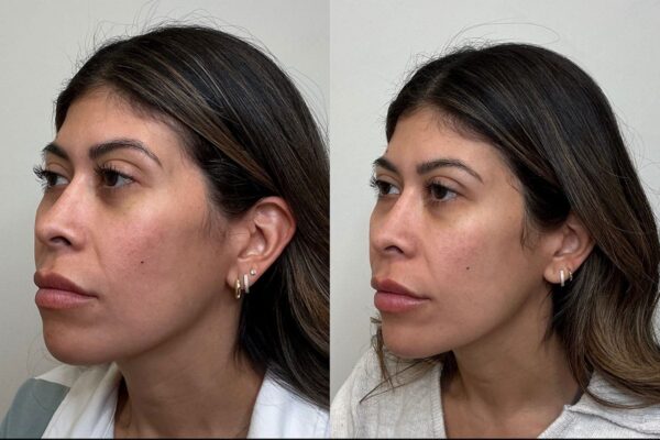 A woman's side profile shows results of Botox in Solana Beach.